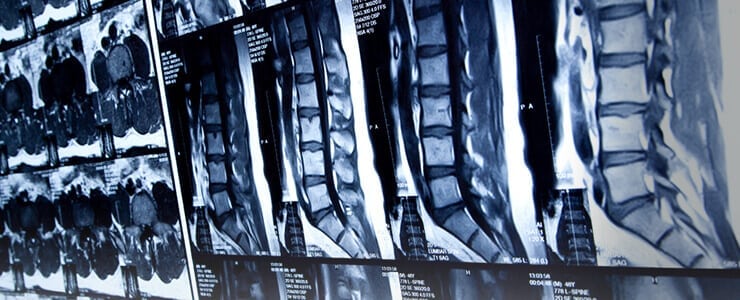 The Spine Institute of Indiana - Spinal Procedures